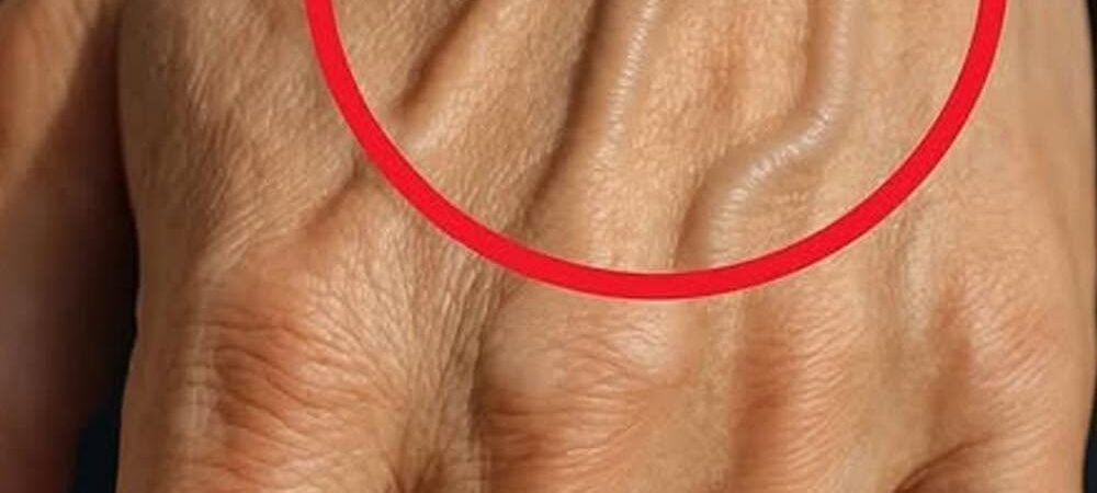 What the Veins on Your Hands Might Reveal About Your Kidney Health