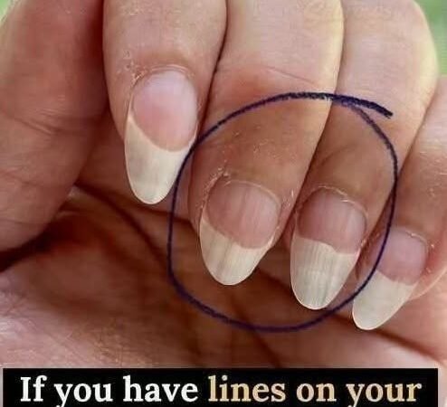 If you have lines on your nails, it means you have…