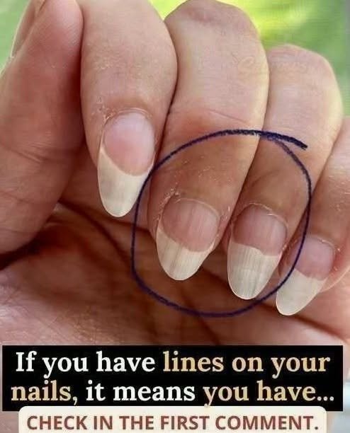 If you have lines on your nails, it means you have…