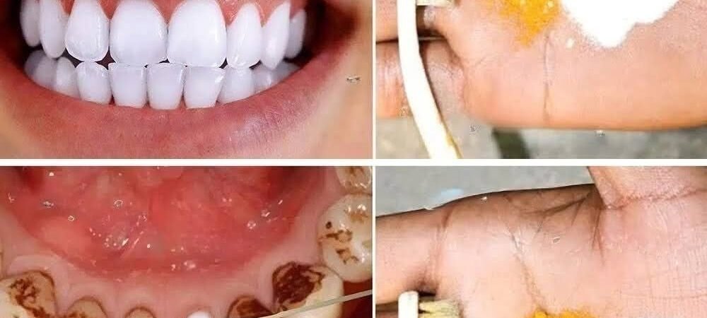 Home Teeth Whitening: Get Whiter Teeth in Just 2 Minutes!