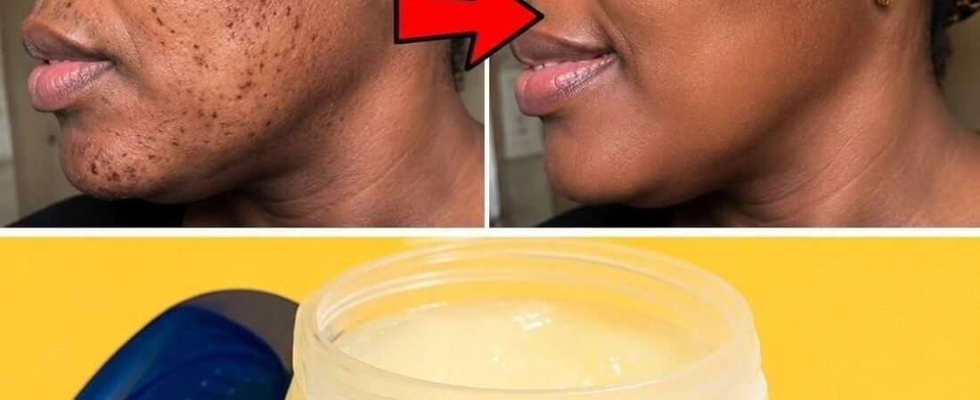 How to remove skin tags naturally at home overnight: the best method with petroleum jelly.